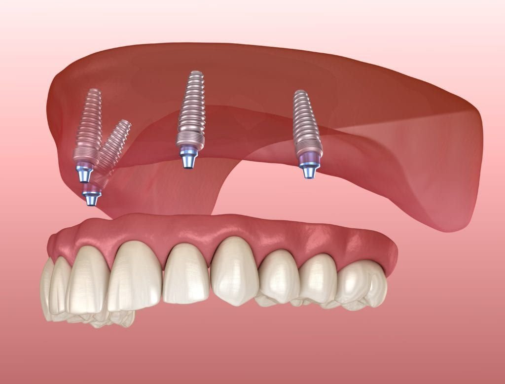 Dental Implants